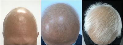 Case Report: Successful Treatment of Alopecia Universalis With Tofacitinib and Increased Cytokine Levels: Normal Therapeutic Reaction or Danger Signal?